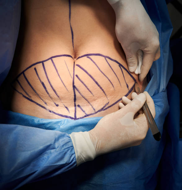 CENTRAL_Day_Surgery tummy tuck Adelaide